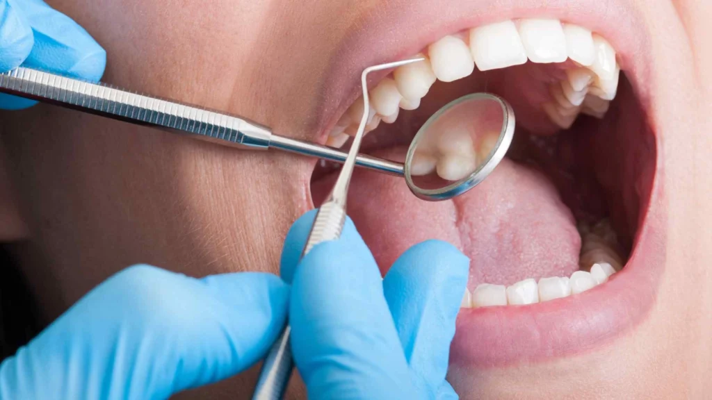 Pasien menyikat gigi dengan benar sebagai langkah mencegah karang gigi menurut dokter The Smile BSD