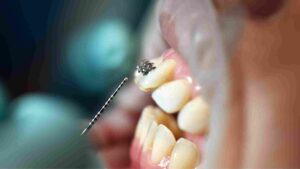 Perbandingan gigi normal dan gigi berantakan sebelum pasang behel