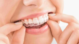 perbedaan behel dan Invisalign dari segi tampilan, kenyamanan, biaya, hingga hasil perawatan.