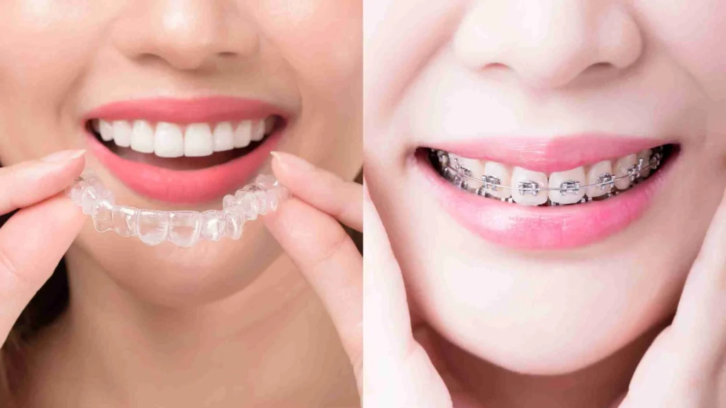 Ada berbagai perbedaan behel dan Invisalign dari segi tampilan, kenyamanan, biaya, hingga hasil perawatan.