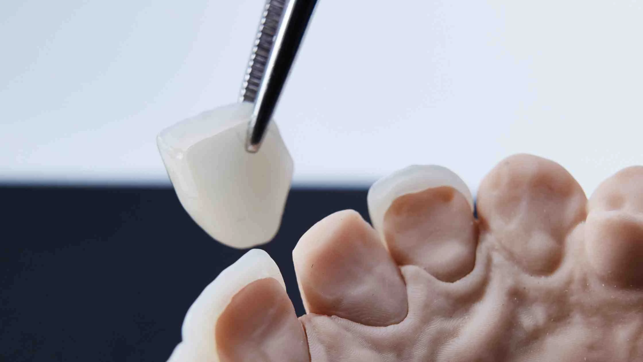 Keramik adalah bahan tambal gigi yang sangat estetik dan bisa digunakan untuk gigi depan atau gigi yang terlihat.