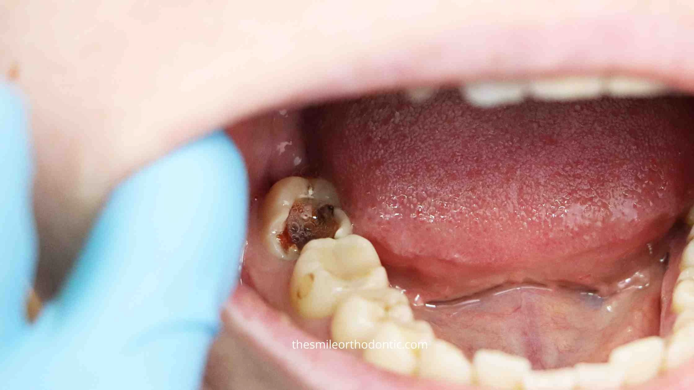 Tambal gigi berlubang parah perlu perhatian khusus karena kerusakan yang lebih dalam pada gigi. Cek penjelasan dokter gigi!