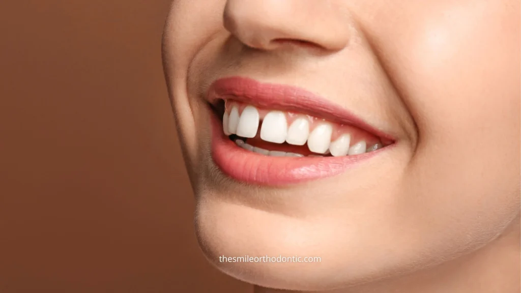 foto overbite pada wanita