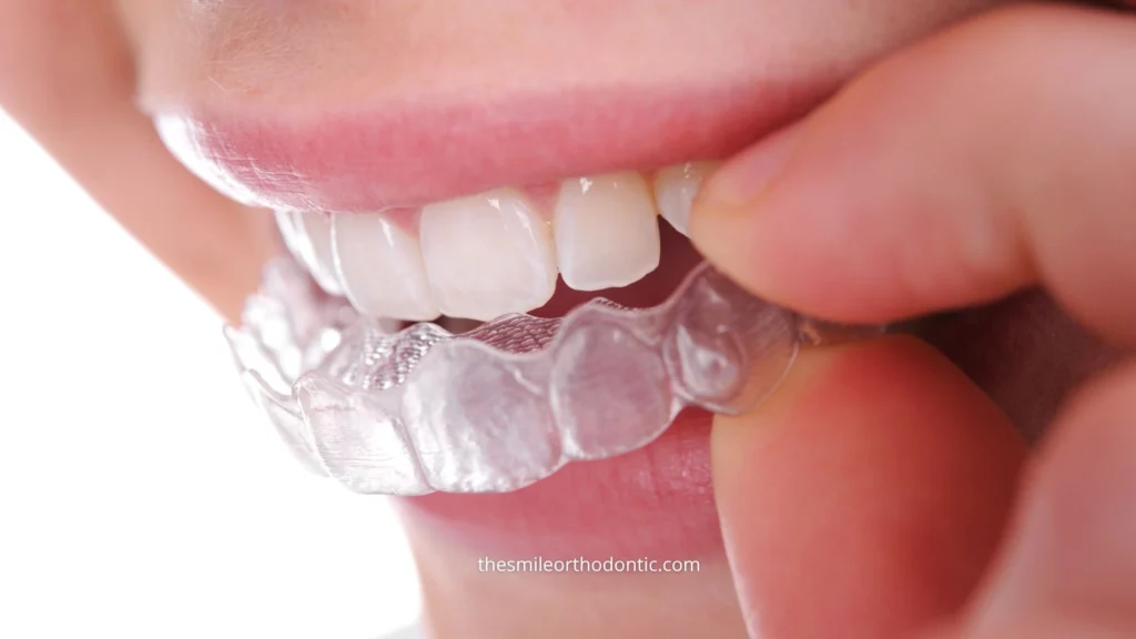 Retainer umumnya perlu digunakan dalam jangka panjang setelah behel dilepas. Ketahui berapa lama dan kapan pemakaiannya dapat dikurangi menjadi malam hari.