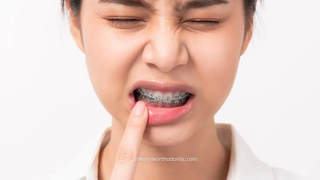 cara mengatasi sakit behel pada gigi