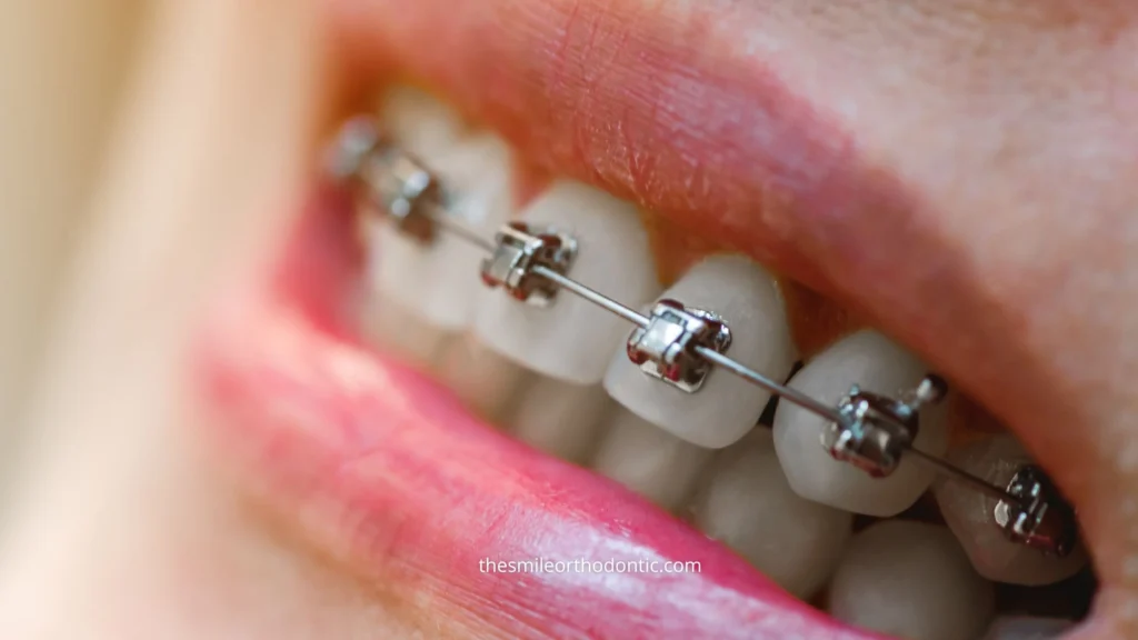 gambar behel self ligating braces