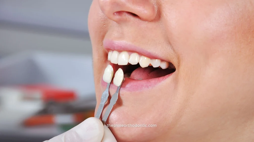 Veneer gigi untuk tujuan estetika tidak ditanggung BPJS. Pahami dasar aturannya, perbedaannya dengan tambal gigi, dan langkah sebelum memilih perawatan.