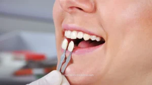 Veneer gigi untuk tujuan estetika tidak ditanggung BPJS. Pahami dasar aturannya, perbedaannya dengan tambal gigi, dan langkah sebelum memilih perawatan.